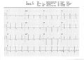 EKG or ECG result from a Treadmill Stress Test Royalty Free Stock Photo