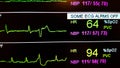 EKG Green Wave Tracing on ICU Monitor