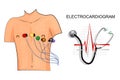 EKG, the patient with the electrodes on the chest. Royalty Free Stock Photo