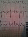 EKG Rhythm Strip showing Tachycardia, QRS and T-waves