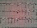 EKG with Rhythm Strip showing Tachycardia on Chest Leads