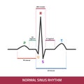 EKG showing normal heartbeat wave. ECG of Normal Sinus Rhythm infographic diagram Royalty Free Stock Photo