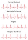 EKG Traces of Normal and Pathologies