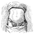 Elastic hernia belt. Illustration of the 19th century.