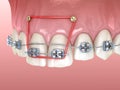 Elastics and metal braces for correction overbite of frontal incisors . Medically accurate dental 3D illustration