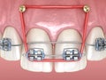 Elastics and metal braces for correction overbite of frontal incisors . Medically accurate dental 3D illustration
