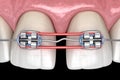 Elastics and metal braces for diastema correction. Medically accurate dental 3D illustration