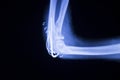 Elbow joint implant xray