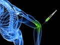 Elbow joint injection Royalty Free Stock Photo