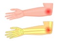 Elbow joint pain_Medial view