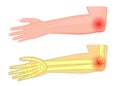 Elbow joint pain