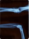 Elbow radiography