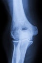 Elbow X Ray