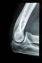 Elbow X-ray Royalty Free Stock Photo