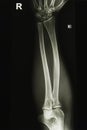 Elbow x-ray image Royalty Free Stock Photo