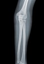 Elbow X-ray negative Royalty Free Stock Photo