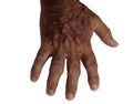 Elderly Male hand with Rheumatoid Royalty Free Stock Photo