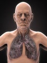 Elderly Male with Lung Cancer Illustration