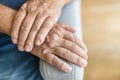 Elderly man suffering from psoriasis on hands Royalty Free Stock Photo