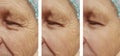 elderly men`s wrinkles on the face before after the procedures Royalty Free Stock Photo