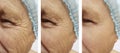 elderly men`s wrinkles removal on the face before after the procedures Royalty Free Stock Photo