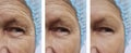 Elderly men`s wrinkles removal medicine dermatology injection health on the face before after the procedures Royalty Free Stock Photo