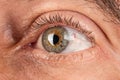 elderly person eyes thinning of the cornea, keratoconus corneal dystrophy.
