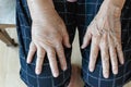 Elderly swollen hand or edema hand Royalty Free Stock Photo