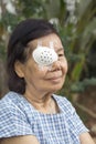 Elderly use eye shield covering after cataract surgery. Royalty Free Stock Photo