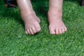 Elderly Woman Bare Swollen Feet On Grass