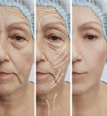 Elderly woman face wrinkles patient therapy beautician rejuvenation before and after correction procedures Royalty Free Stock Photo