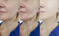 Elderly woman face plastic beautician therapy rejuvenation wrinkles tightening before and after treatment arrow Royalty Free Stock Photo