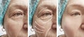 Elderly woman face wrinkles dermatology therapy beautician rejuvenation before and after correction procedures Royalty Free Stock Photo