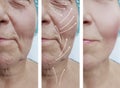 Elderly woman face wrinkles therapy beautician rejuvenation before and after correction procedures Royalty Free Stock Photo