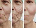 Elderly woman face wrinkles therapy rejuvenation before and after correction procedures Royalty Free Stock Photo