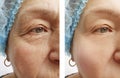 Elderly woman face wrinkles, before and after hydrating collagen procedures Royalty Free Stock Photo