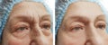 Elderly woman face wrinkles, before and after collagen procedures Royalty Free Stock Photo