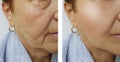 Elderly woman face wrinkles removal before and after lifting therapy procedures Royalty Free Stock Photo