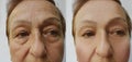 Elderly woman face wrinkles removal results health before and after lifting therapy procedures Royalty Free Stock Photo