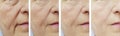 Elderly woman face wrinkles before after treatment