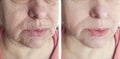 Elderly woman face wrinkles skin  lift  rejuvenation before and after cosmetology treatment Royalty Free Stock Photo