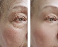 Elderly woman facial wrinkles correction before and after cosmetology procedures Royalty Free Stock Photo