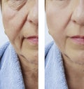 Elderly woman facial wrinkles results correction before and after cosmetology procedures Royalty Free Stock Photo