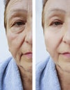 Elderly woman facial wrinkles results before and after cosmetology procedures Royalty Free Stock Photo