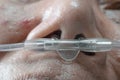 Elderly woman with nasal breathing tube