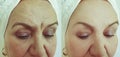 Elderly woman removal sagging wrinkles before after treatment therapy collagen tightening mature plastic result