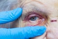 Elderly woman`s injured eye & nurse`s fingers