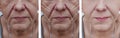 Elderly woman`s wrinkles face correction before and after problemcorrection procedures Royalty Free Stock Photo