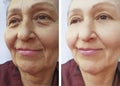 Elderly woman`s wrinkles mature correction results contrast before and after procedures Royalty Free Stock Photo