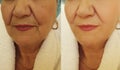 Elderly woman wrinkles face before after correction cosmetology regeneration treatment Royalty Free Stock Photo